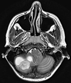 Cerebellar Hemangioblastoma, MRI