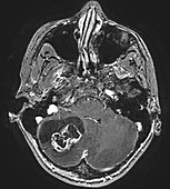 Cerebellar Hemangioblastoma, MRI