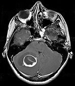 Cerebellar Hemangioblastoma, MRI