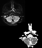 PET MRI Scan of Lymphoma