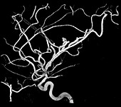 3D Angiogram of Aneurysm