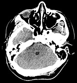 Rhomboencephalosynapsis, CT scan
