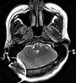 Rhomboencephalosynapsis, MRI