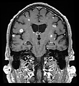 Metastatic Disease to Brain, MRI