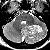 Lhermitte-Duclos Disease, MRI