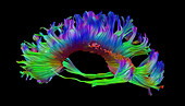 Corpus Callosum, Diffuse Tensor Imaging