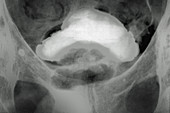 Prostate Cancer, X-ray