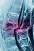 Lumbar Vertebrae Dislocation, MRI