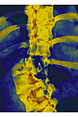 Rotational Dislocation of Scoliosis, X-ray