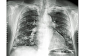 Lung Metastases, X-ray