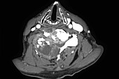 Spinal Tumour, CT Scan