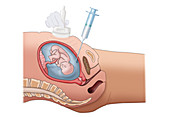 Amniocentesis, Illustration