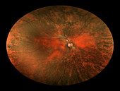 Bilateral Melanosis of Eye
