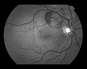 Retinal Hem and Macular Edema