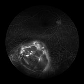 Choroidal Melanoma, 8 of 8