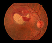 Retinal Artery Macroaneurysm