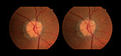Optic Nerve Head Druzen, stereo image