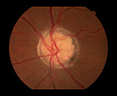Optic Nerve Head Druzen