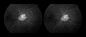 Capillary Hemangioma, stereo image