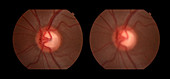 Congenital Vascular Loop, stereo image