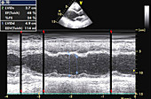 Echocardiogram