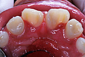 Dens in Dente Malformation Repair