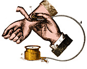 Sphygmomanometer, 1883