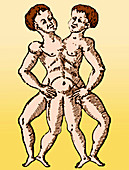 Conjoined Twins, 16th Century