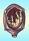 Abnormal Fetal Presentation, 16th Century
