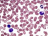 Peripheral blood smear, LM