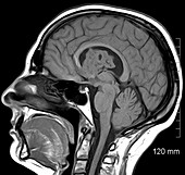 Brain Subependymoma, Sagittal T1 weighted MRI