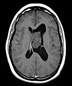 Brain Subependymoma, Axial T1 weighted MRI