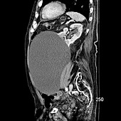 Giant Benign Renal Cyst, CT
