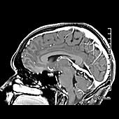 Lipoma of Supracerebellar Cistern, MRI