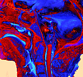 Enhanced Cadaver Slice of Brain