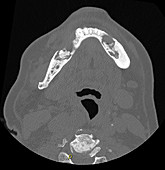 Biphosphonate Osteonecrosis of Mandible, CT