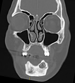 Biphosphonate Osteonecrosis of Mandible, CT