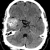 Cavernous Malformation, CT