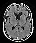 Extensive Dural Sinus Thrombosis, MRI