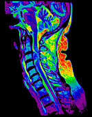 Cervical Spine Meningioma, MRI