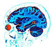 Sagittal Brain MRI