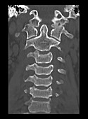 Type III Occipital Condyle Fracture, CT