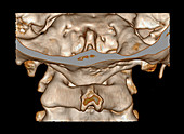 Congenital Assimilation of C1 to Skull Base, CT