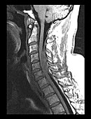 Cervical Epidural Hematoma, MRI