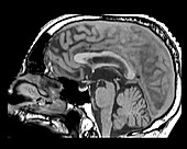 Progressive Supranuclear Palsy (PSP), MRI