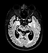 Progressive Supranuclear Palsy (PSP), MRI