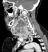 Large Thyroid Goiter, CT