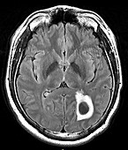 Cysticercosis, MRI