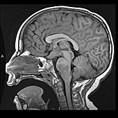 Neurofibromatosis type I (NF1), MRI