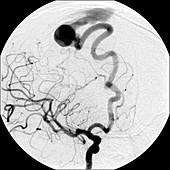 Angiogram of AV Fistula